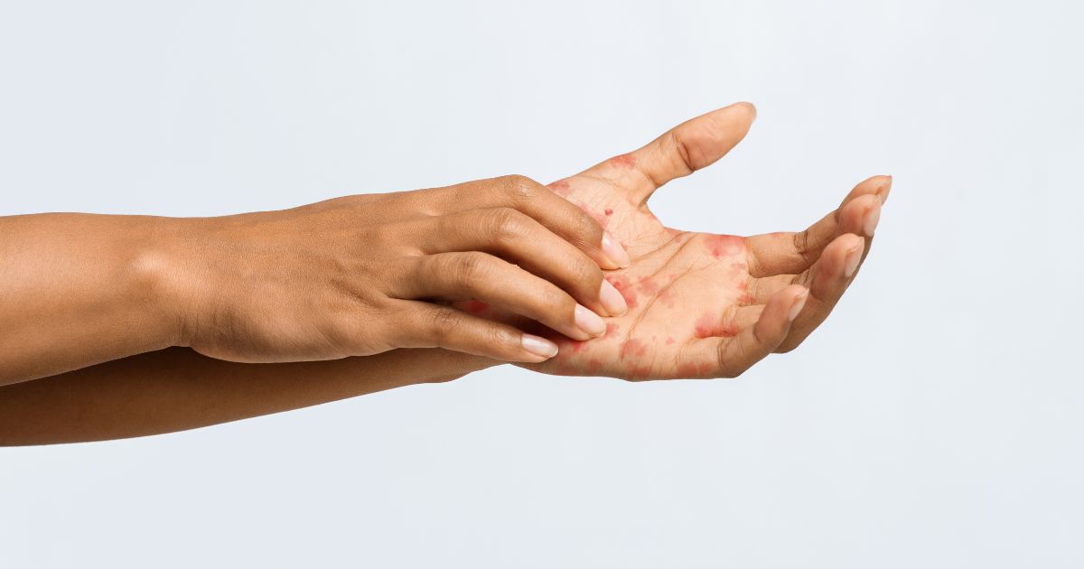 nejlepsi-krem-na-popraskane-ruce-ekzem